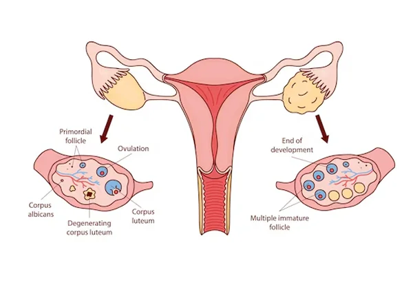 PCOD or PCOS